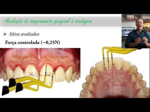 Vídeo: No índice de sangramento gengival?