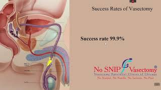 Vasectomy Success Rates