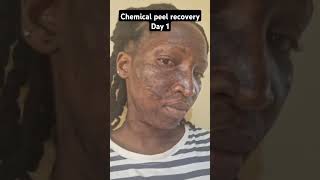 Chemical Peel Recovery - Day 1
