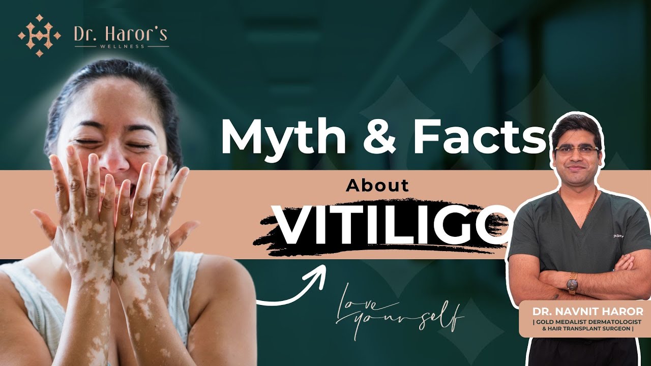 Vitiligo : Myths vs Fact ||  Best Dermatologist in Delhi explains