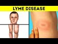 Had I Known The Lyme Disease Symptoms Earlier, I&#39;d Have Avoided Complications