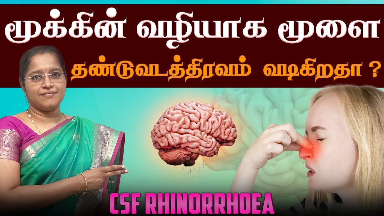 மூக்கின் வழியாக மூளை தண்டுவடத் திரவம் வடிகிறதா ? | CSF Rhinorrhoea | Dr A.VENI  | Trichy