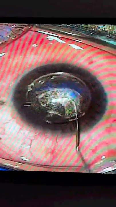 ReLEX Smile Eye Surgery - The First Minimally Invasive Flap Less Solution.  #eye #smileeyesurgery