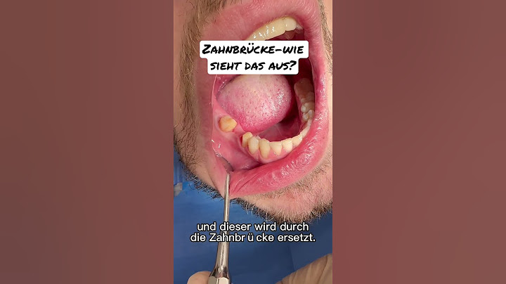 Zahnbrücke-Wie sieht’s im Mund aus? #zahnersatz #schönezähne #brücke #zahnlücke #zahnarzt