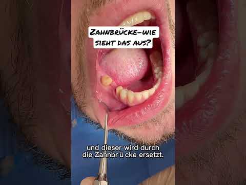 Video: 4 Möglichkeiten zur Pflege Ihres Zahnersatzes