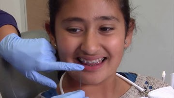 Cách vệ sinh răng khi đeo mắc cài