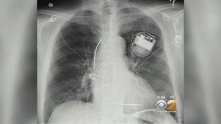 Can Pacemakers Be Hacked?