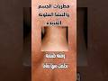 علاج التينيا الملونة اسرع وصفة لتينيا الجلد علاج التينيا الملونة اسرع وصفة لتينيا الجلد
