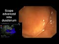 Linear eus of the pancreas dr saurabh gupta sydney australia