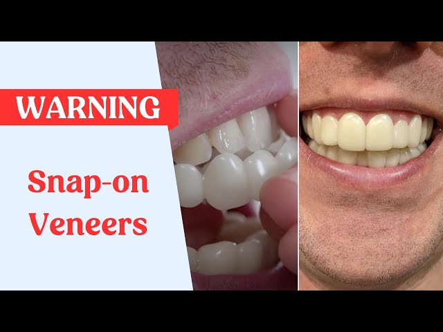 6 Sets Veneers Snap in Teeth, Teeth Filling Kit Permanent for Snap