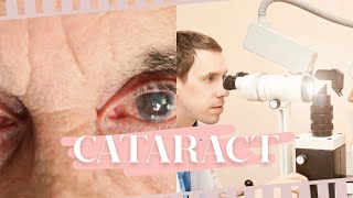 Cataract | Definition | Causes | Factors | Symptoms | Prevention | Solution |