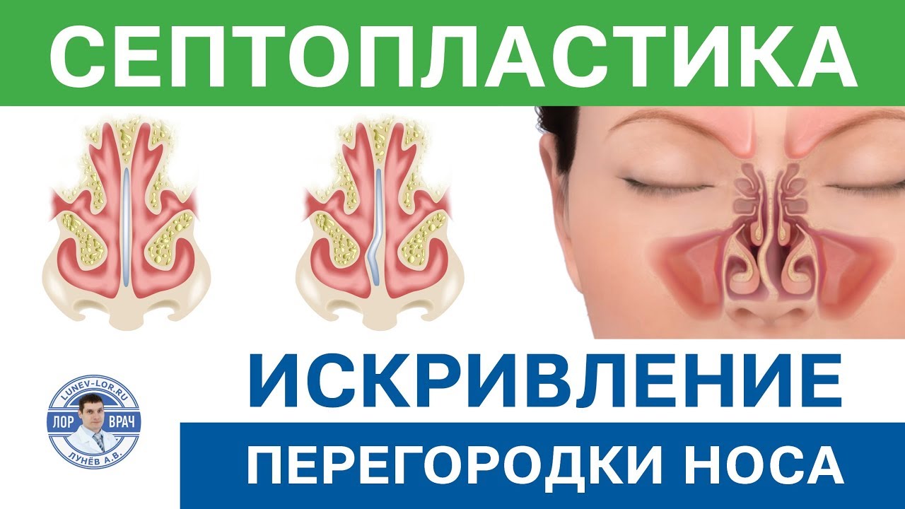 Septum операция Подслизистая резекция перегородки носа 2 - YouTube