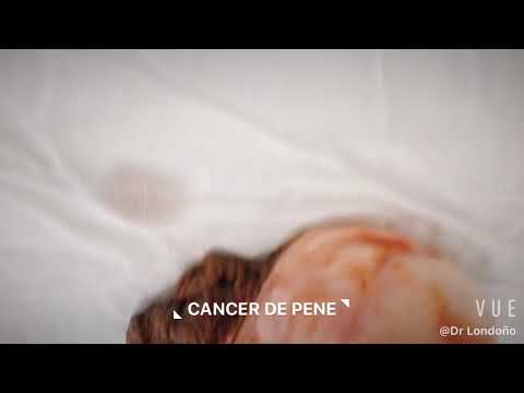 Vídeo: Penectomía Para El Cáncer De Pene: Recuperación, Procedimiento Y Más