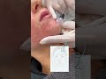 Aquashine l facial rejuvenation