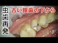 古い銀歯の下から虫歯が再発⁈虫歯菌の侵入を防ぐ方法! Tooth Decay Under Stainless Steel Crowns 虫牙从旧银牙復发?防止虫牙细菌入侵的方法