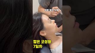 #짧은코성형 7일차 #부목제거  직후
