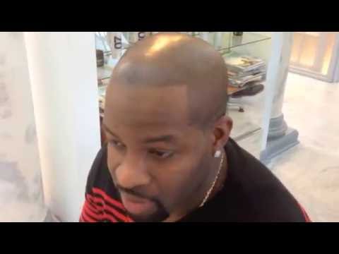 Video thumbnail: Micropigmentation Treatment | Hair Loss Alternative | Scalp Treatment