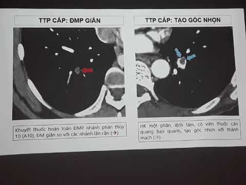 [Chest CT] - Pulmonary Embolism CT Dr. Thuy.