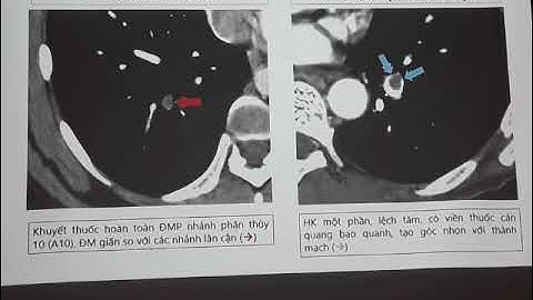 [ CT NGỰC ] - CT THUYÊN TẮC PHỔI Bs Thuỳ.