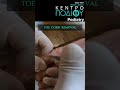 Toe Corn Removal|Αφαίρεση Επιδακτύλιου Τύλου|Κέντρο Ποδιού Podiatry|Podiatrist|Podologos|Ποδίατρος