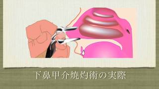 鼻はなぜつまる？