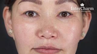 InterCharm - 3 hour skin tightening service