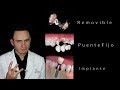 Puentes vs Implantes | ¿Cuál es la mejor opción? | Dentista en Querétaro