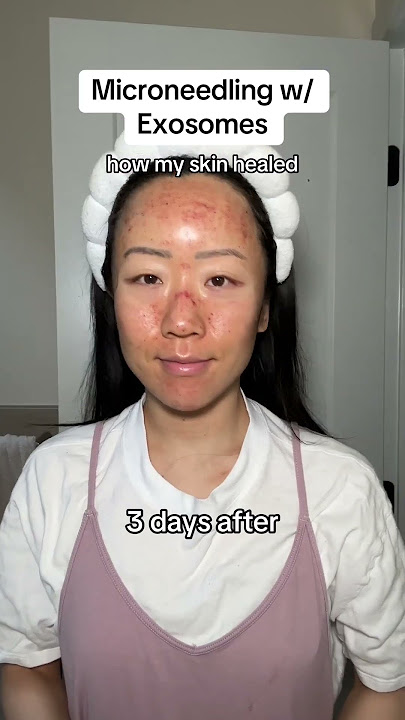 My results from Microneedling with Exosomes! First 7 days post treatment #shorts
