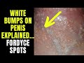 Doctor explains fordyce spots  granules  small white spots or pimples on the penis