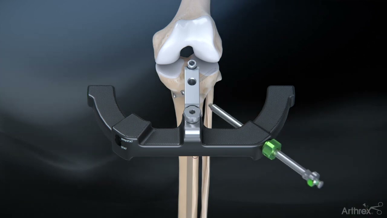 Fracture du tibia - Chirurgie enclouage centro-médullaire - Dr Simon Tournemine