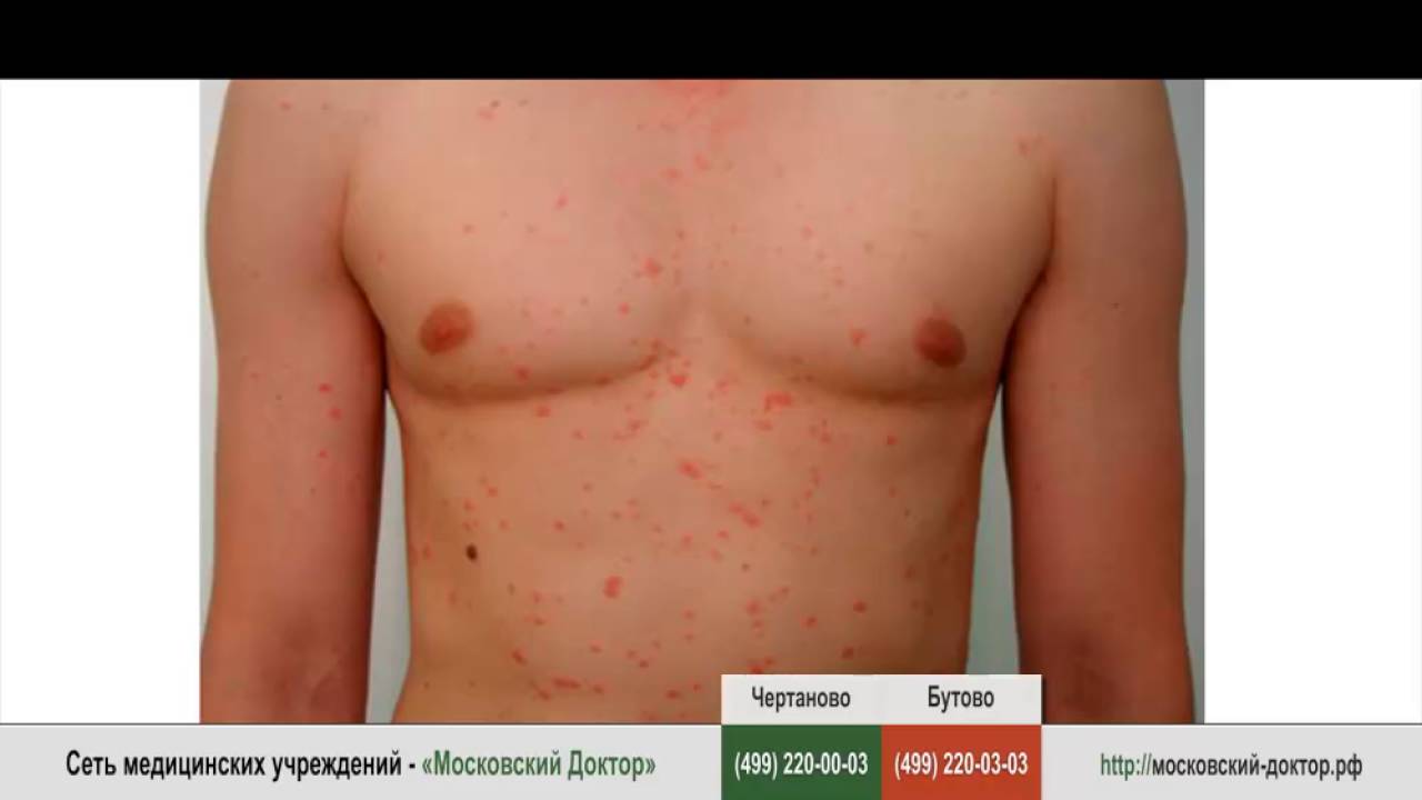Как проявляется аллергия на птиц