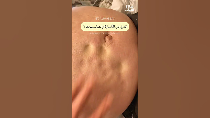 مو كل ورم يعني مي، ومو كل تورم ينضغط ويترك حفرة