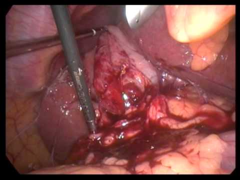 Lap  Cholecystectomy Unedited 305 Chronic Cholecystitis With Very Strong Omental Adhesion
