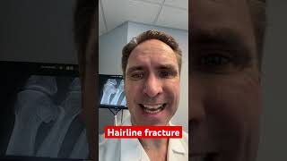 Hairline fracture in CrossFit patient