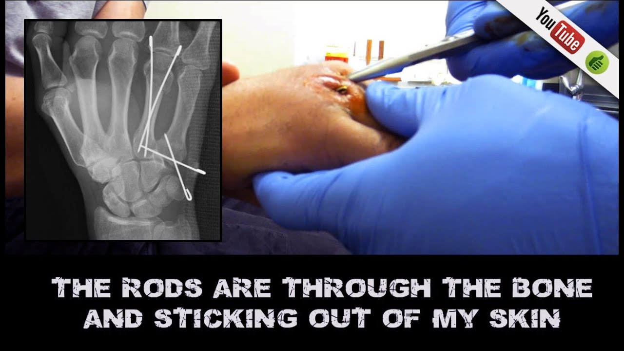 Removing 4 Rods pins From Boxers Break No Anesthetic YouTube