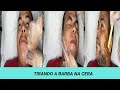 DEPILANDO A BARBA COM CERA ELÁSTICA