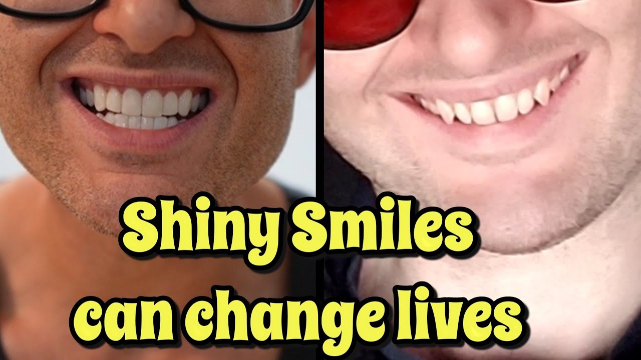 Shiny Smile Veneers Honest 6 Month Review Everything you need to