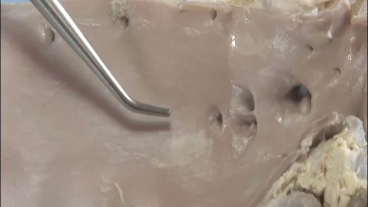 Atherosclerosis   Cadaveric Dissection