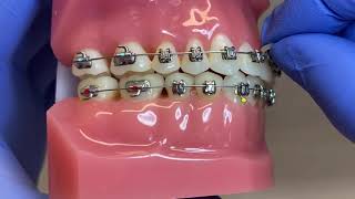 Elastics - Class II Shudy (L Shape)
