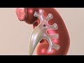 Kidney stone treatments