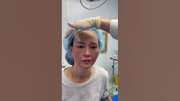 Mí lật và cách xử lý