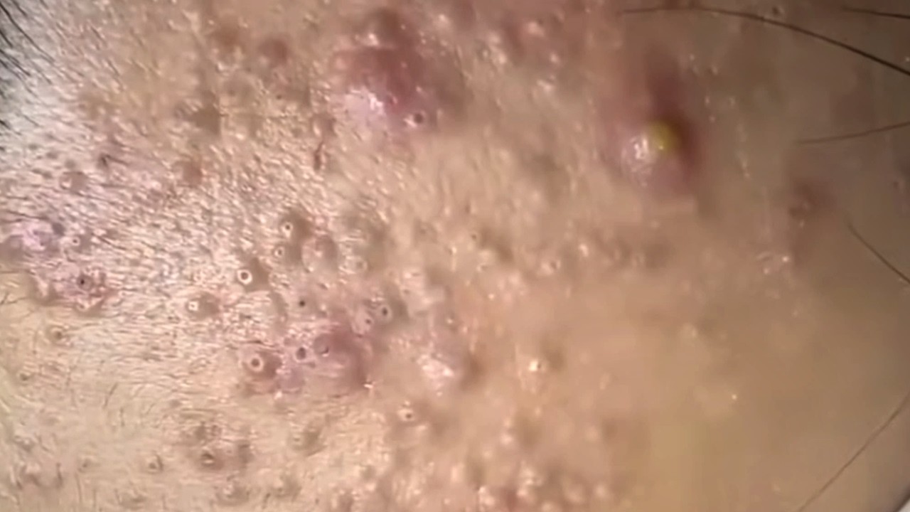 Blackheads & Whiteheads Satisfying Removal Acne and Pimple @08094