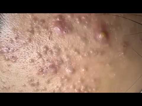 Blackheads & Whiteheads Satisfying Removal Acne and Pimple @08094