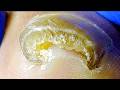 Ingrown Toenails That Have Grown Curly For Many Years, Perfectly Cured【Xue Yidao】