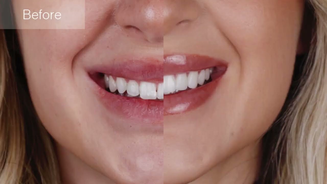 วีเนียร์ Veneers ทำฟันสวยแบบดารา Floss Dental Clinic Dental Clinic