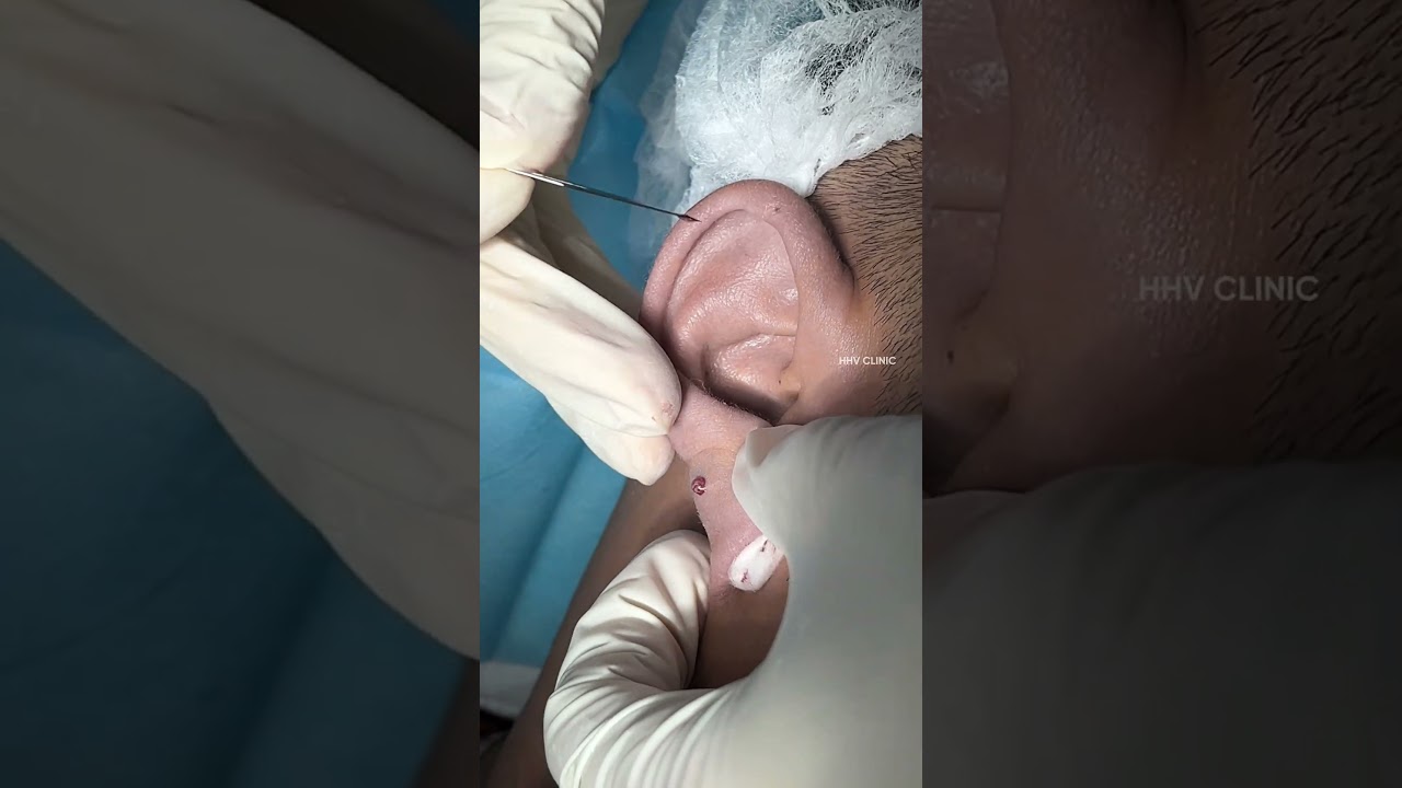 Nặn mụn u nang bã vùng tai an toàn không để sẹo.