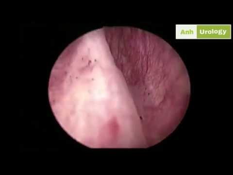 Phẫu thuật nội soi cắt U tuyến tiền liệt - Transurethral Resection of the Prostate P3