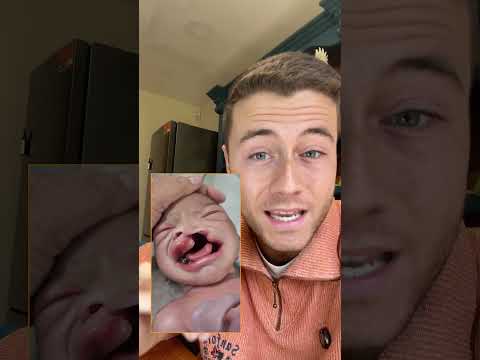 Labio Leporino y Vit B9