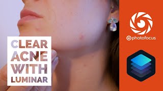 Removing Acne with Luminar 4 and AI Skin Enhancer screenshot 4