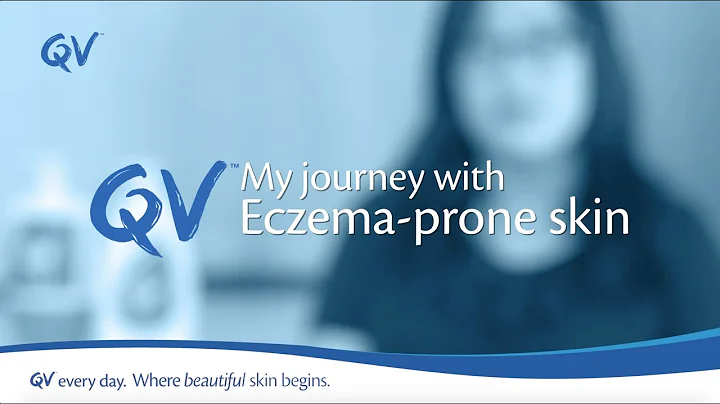 QV Skincare: My Journey With Eczema Prone Skin ft. the founder of Eczema Support Group Singapore